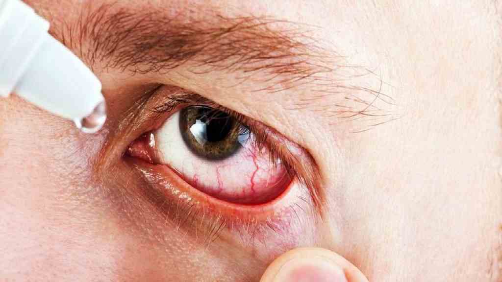 आंखों पर फ्लू का अटैक, नेत्र ओपीडी में 90 फीसदी रोगी मिले पीड़ित; यहाँ पढ़े आई फ्लु के लक्षण और बचाव के तरीके Eye Flu