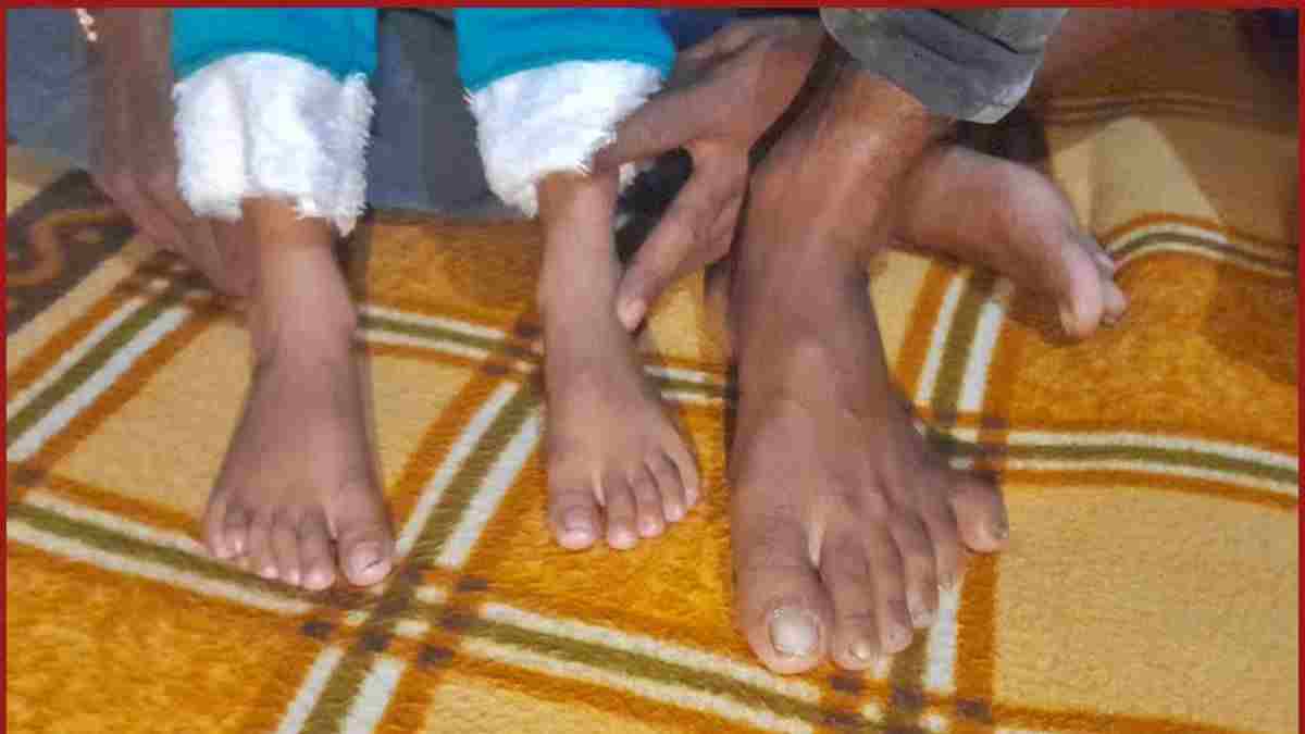 हरियाणा का ऐसा परिवार जिसमें सभी सदस्यों की 20 से अधिक उंगलियां, बेटियों की शादी के बाद बच्चों की भी 6 उंगलियां More Than 20 Fingers Family In Panipat 1